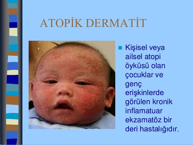 Çocuklarda akut dönemde atopik dermatit tedavisi Çocuklarda akut dönemde atopik dermatit tedavisi